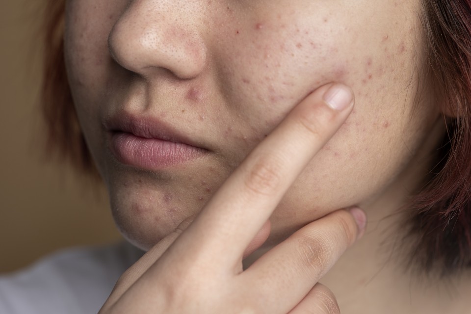 Que tipos de acne existem?