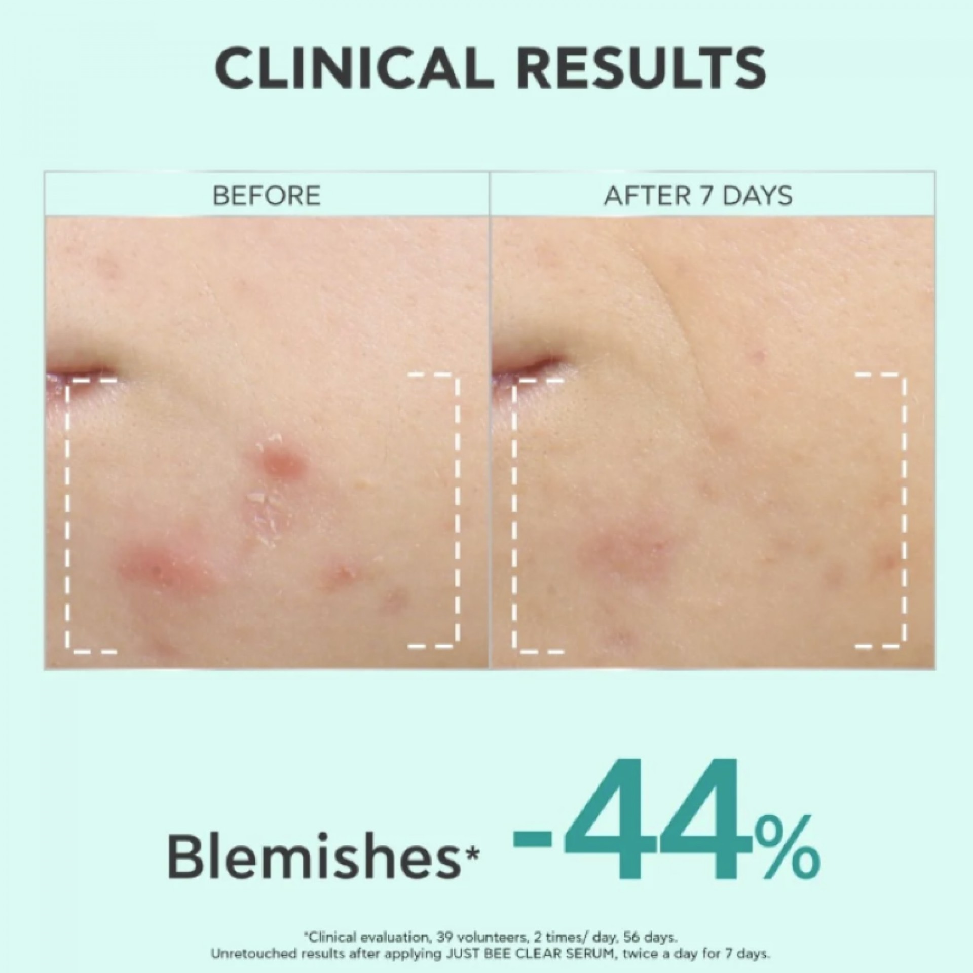 Apivita Just Bee Clear Anti-Blemish Serum 30ml